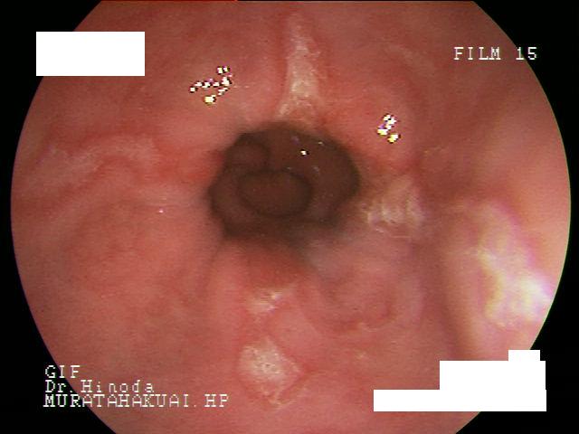逆流性食道炎の内視鏡検査写真です